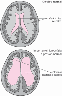 EDEMA POR TRATAMIENTO MEDICO