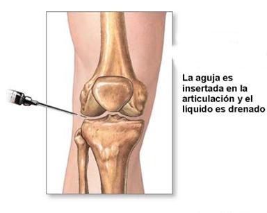 Liquido sinovial rodilla