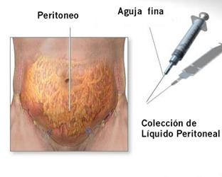 LIQUIDO PERITONEAL. es la acomulacion del liquido peritoneal, tambien denominado ascitis, en la cavidad abdominal.El liquido 