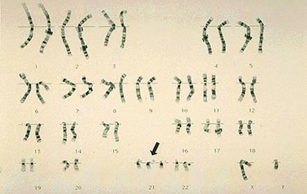 Sindrome Con 21 Cromosomas