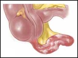 Síntomas y signos en la apendicitis aguda - Monografias.com