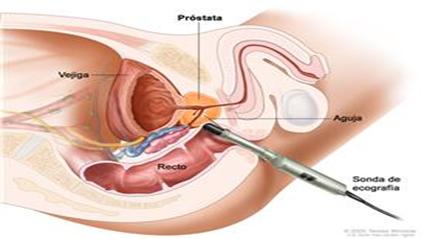 Ultra sonografía transrectal: