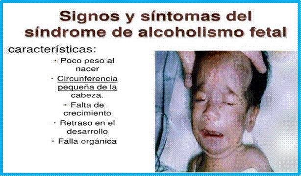 sindrome de alcoholismo fetal imagenes