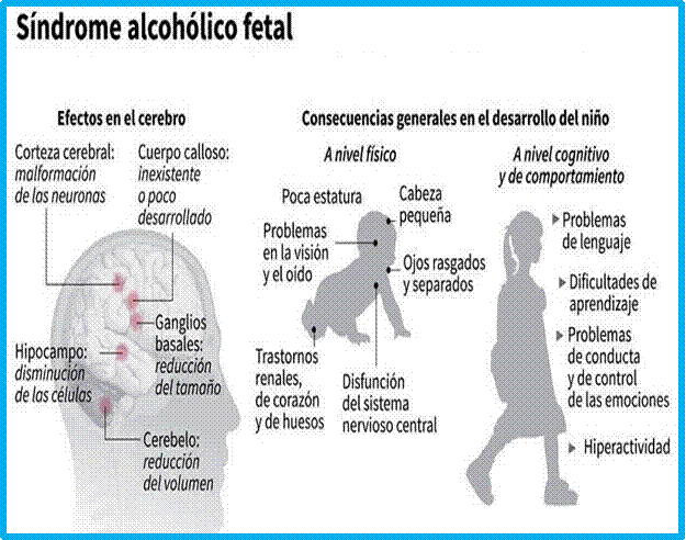 sindrome de alcoholismo fetal secuelas