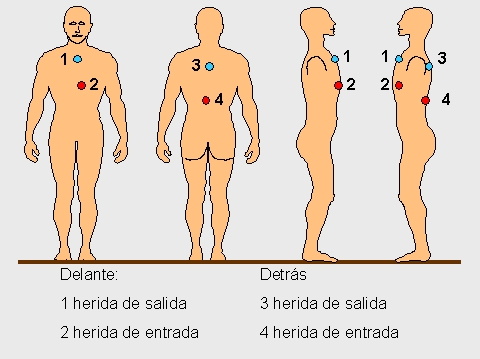 heridas de entrada y salida por arma de fuego