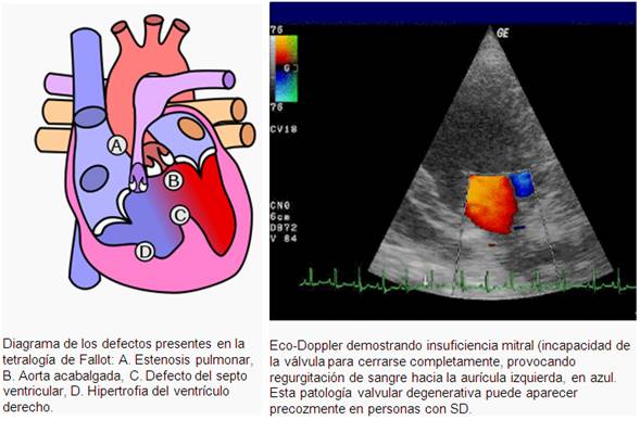 El Sindrome De Down Pagina 2 Monografias Com