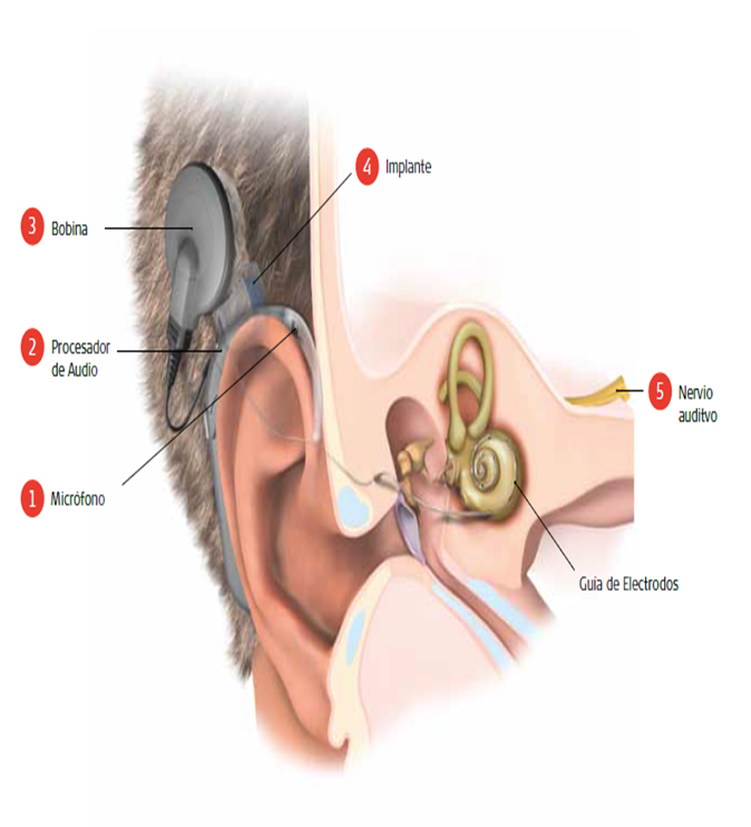 análogo de los implantes cocleares