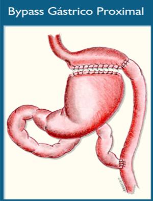 Cirugia Bariatrica Pagina 2 Monografias Com