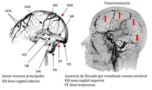 seno sagital inferior